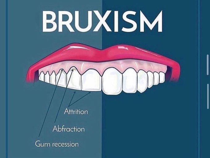 Bruxism