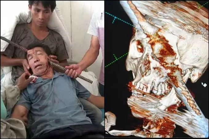 A very serious case where a rod has been gone from skull and come out through skull