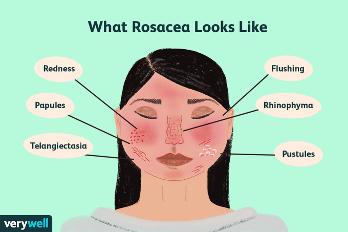 Who Gets Rosacea