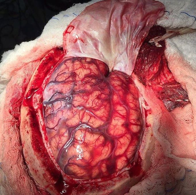 Decompressive craniectony done in a patient that suffered an ischemic stroke...