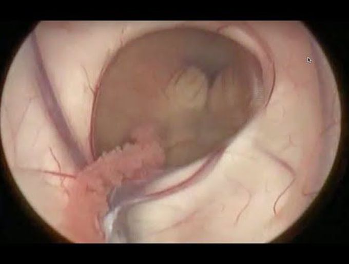 Minimally invasive brain surgery (third ventriculostomy) through a keyhole approach.