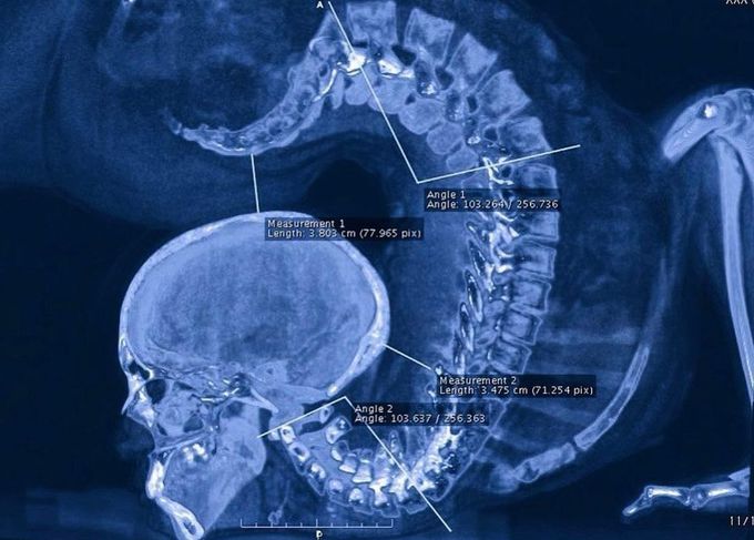 X-ray of a contortionist performing an exercise!!