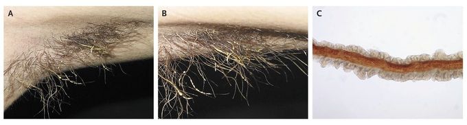 Trichomycosis Axillaris