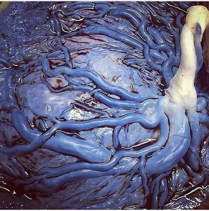 The Placenta and umbilical cord.