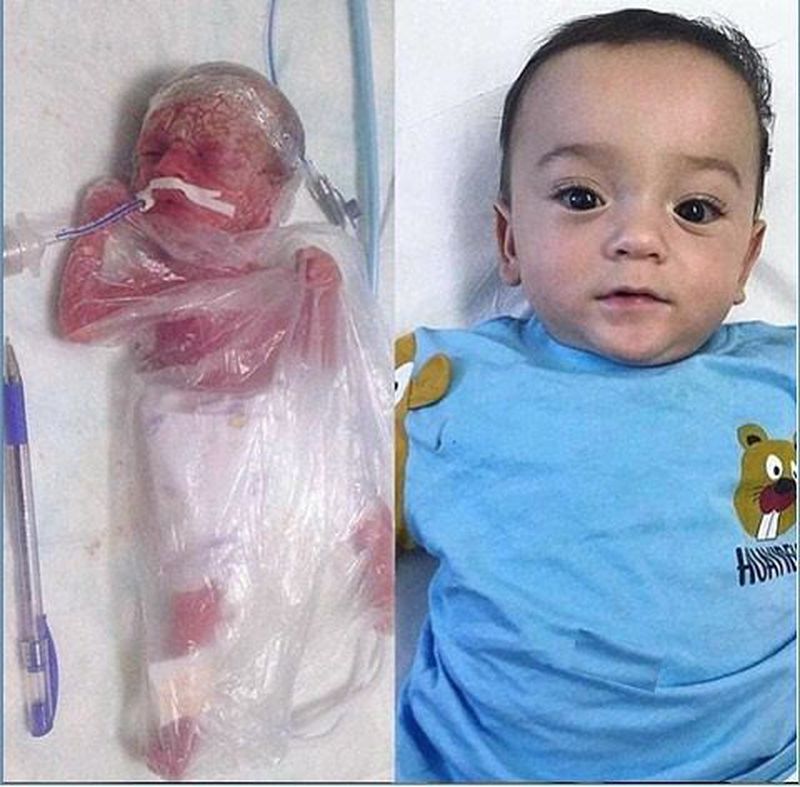 LBW due to premature birth LBW due to premature birth
