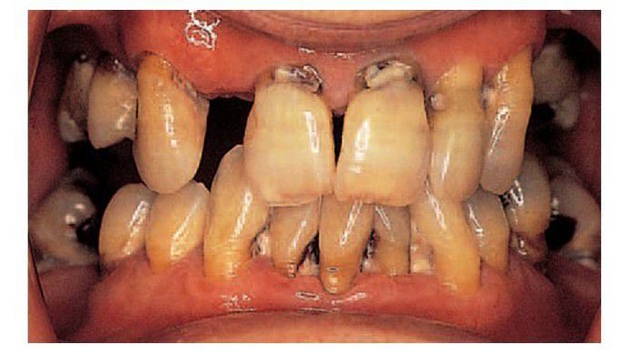 Sjögren’s syndrome