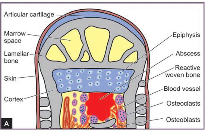 Pathogenesis of pyogenic osteomyelitis