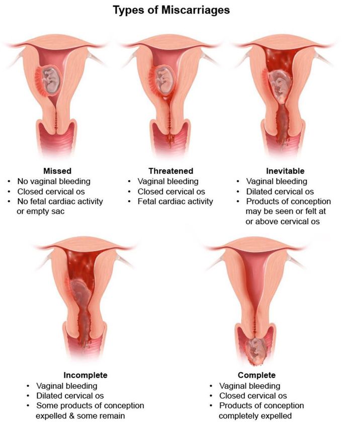 Types of miscarriage
.