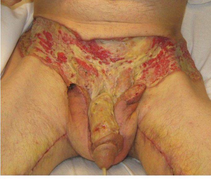 Type of gangrene????