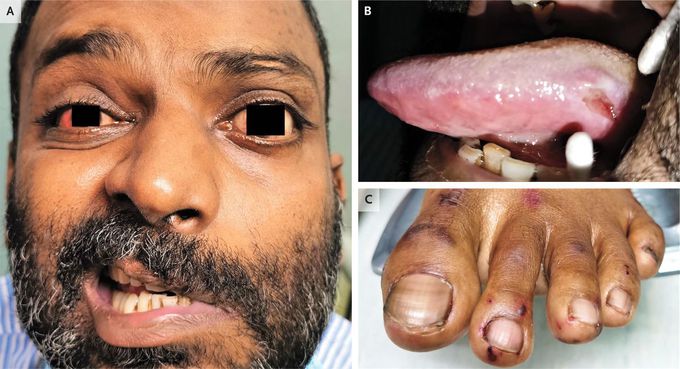 Eosinophilic Granulomatosis with Polyangiitis