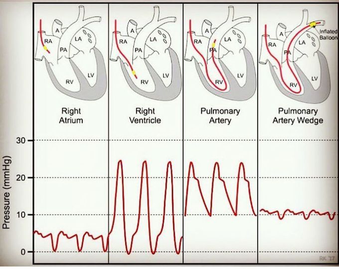 The  pulmonary wedge  pressure or  (pwp)