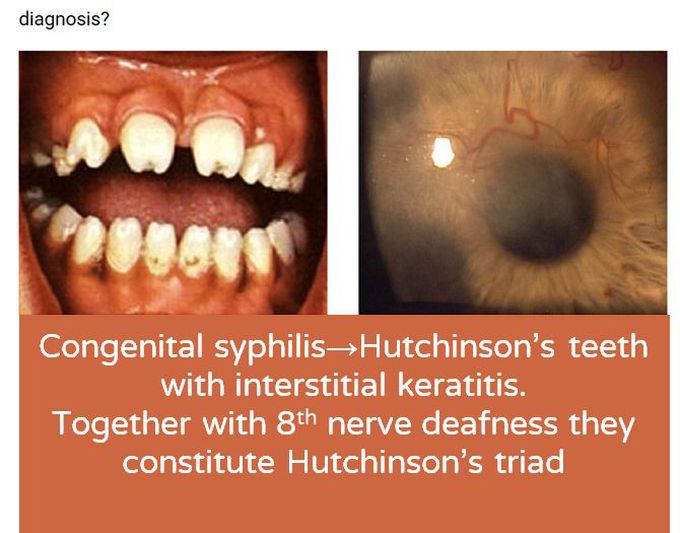 congenital syphilis