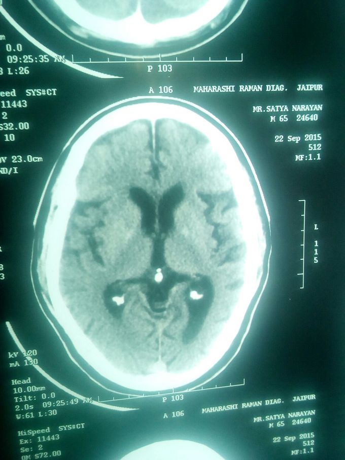 MRI Brain