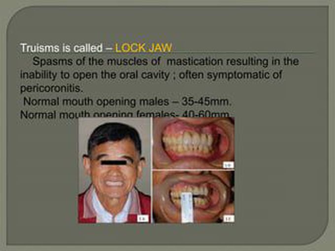 Cause of Trismus