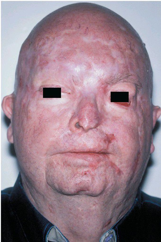 Nevoid Basal Cell Carcinoma Syndrome