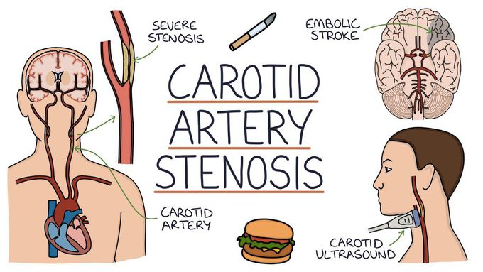 Understanding Carotid Artery Stenosis