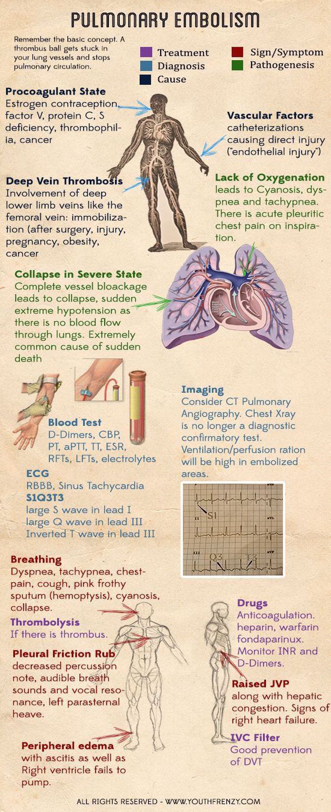 pulmonary embolism