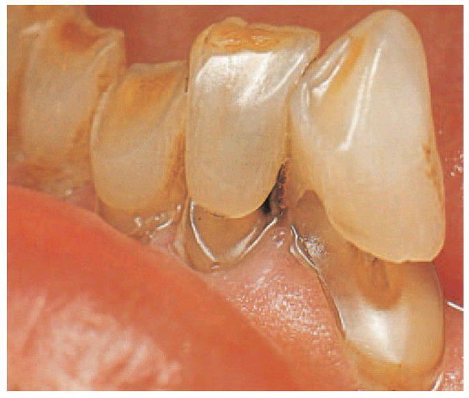 Attrition and abrasion.