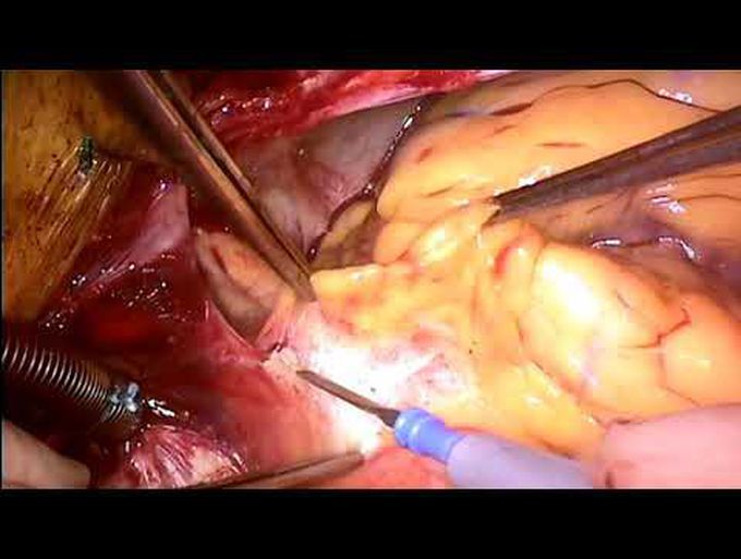 Intramural Coronary Artery Unroofing