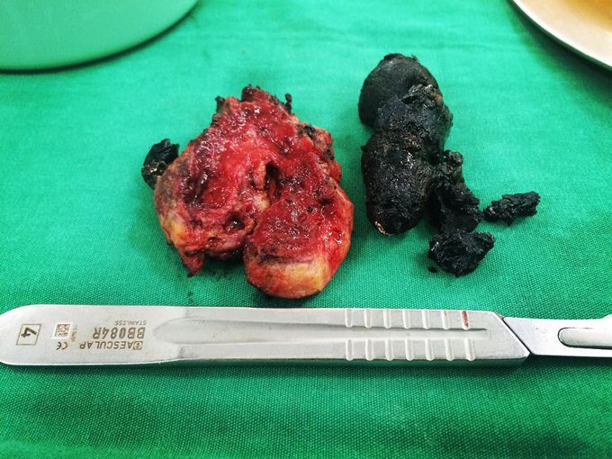 Gallbladder thickening