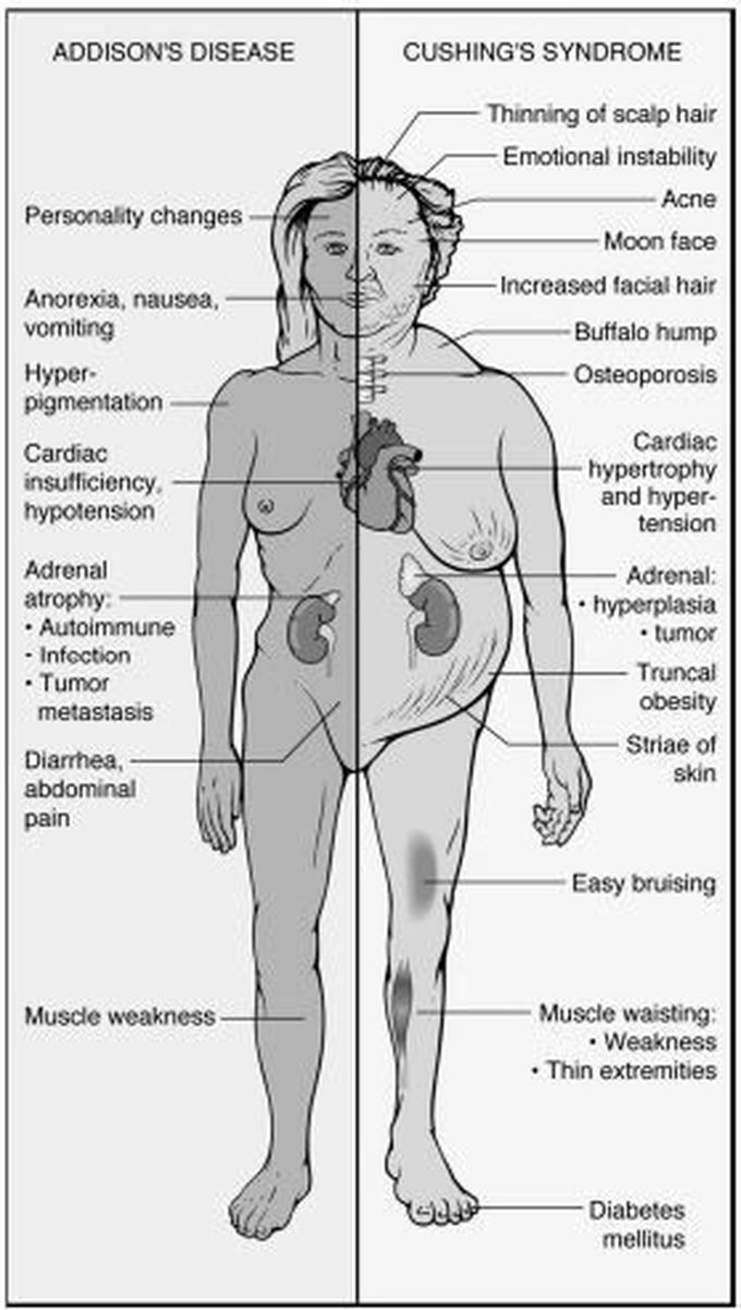 Addison’s disease vs Cushing’s syndrome