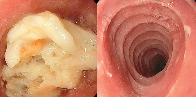 Trachealization of the esophagus