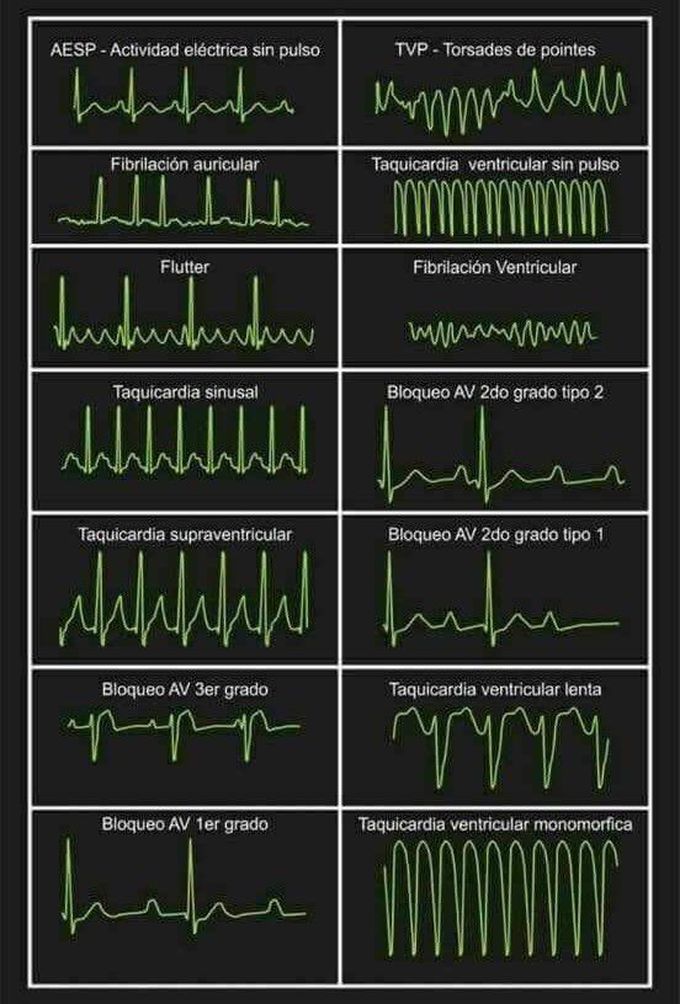 ECG