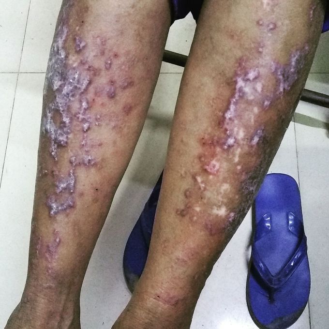 Lichen Planus