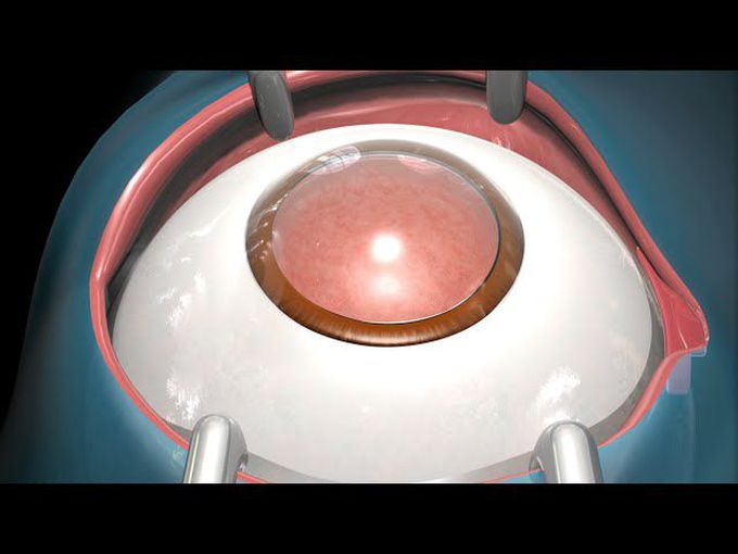 Cataract Surgery (Animated)