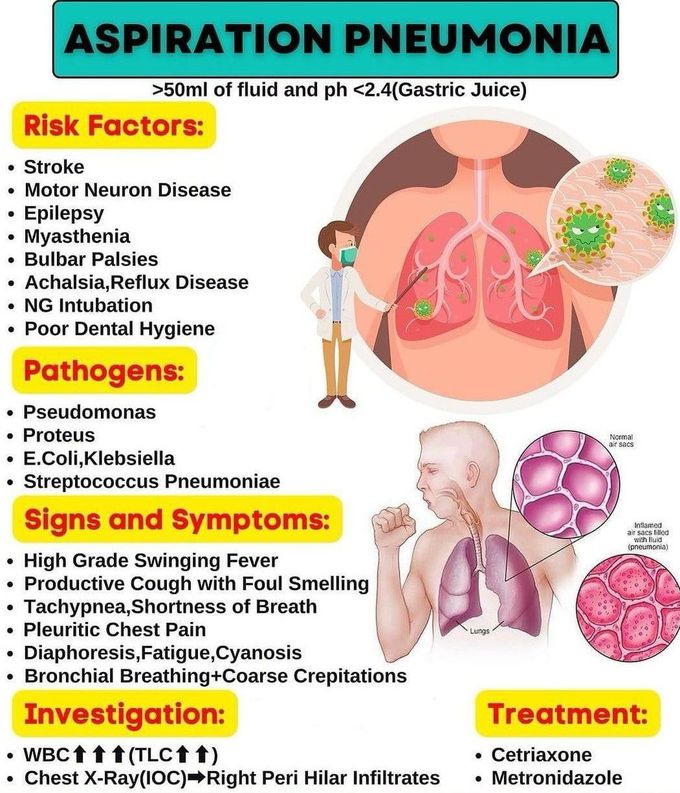 Aspiration Pneumonia