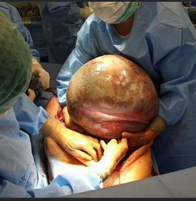 Ovarian tumor