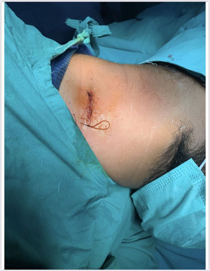 Simple suture