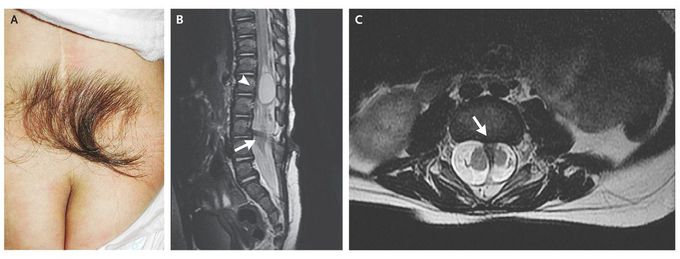 Occult Spinal Dysraphism