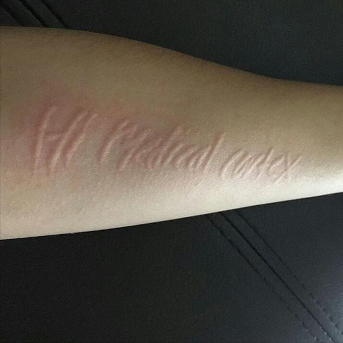 Dermatographia