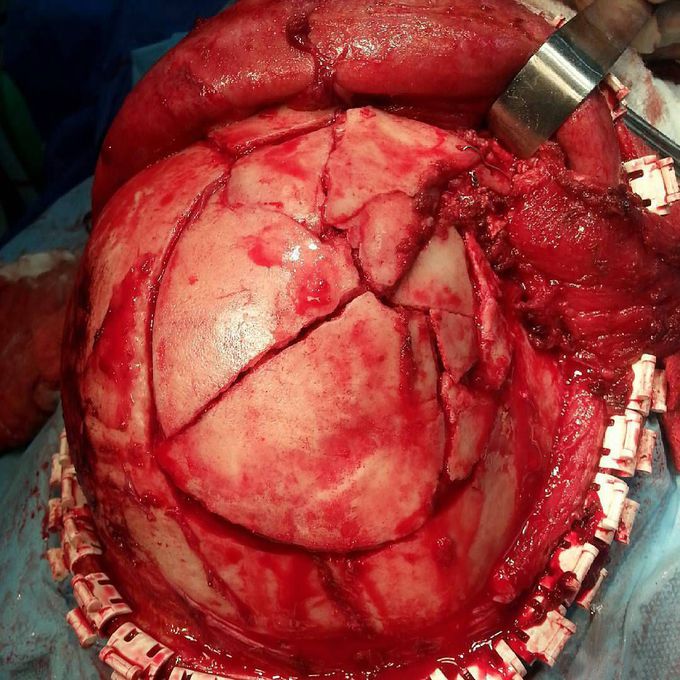 Depressed frontal fractre of the skull