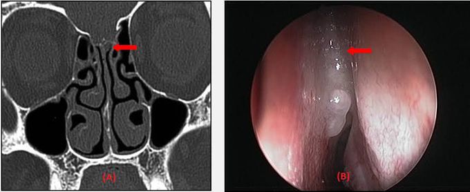 Csf rhinorrhea