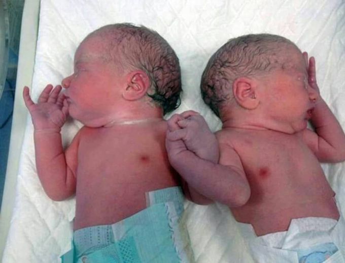 A beautiful photo of twins holding hands right after birth! ❤ 