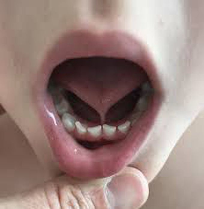 Complications of tonguetie