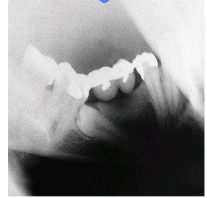 Impacted teeth under fixed prosthesis