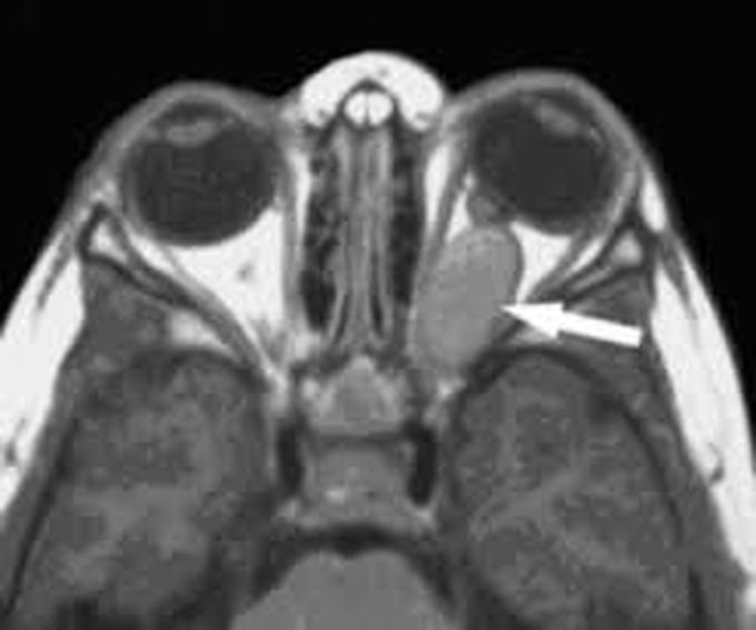 How is optic nerve glioma diagnosed?