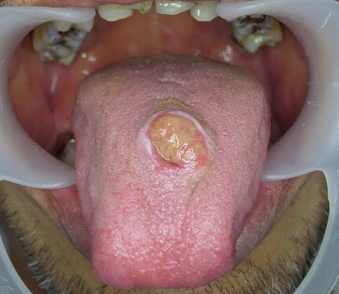 Adenosquamous Carcinoma