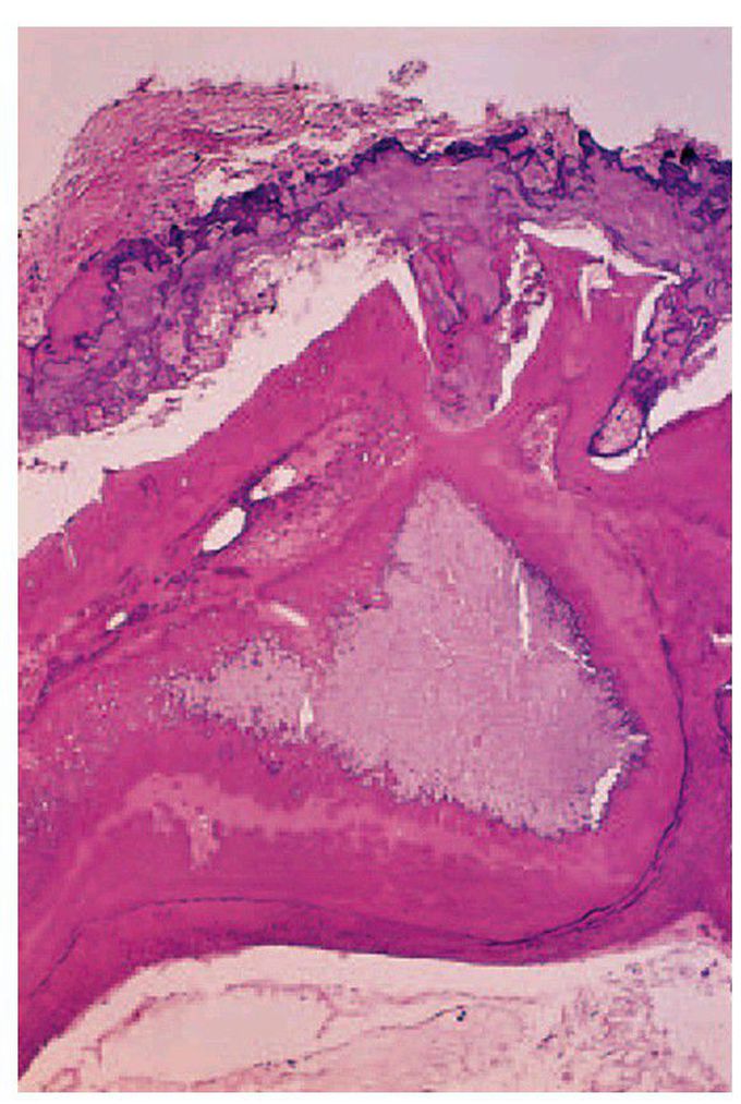 Regional odontodysplasia