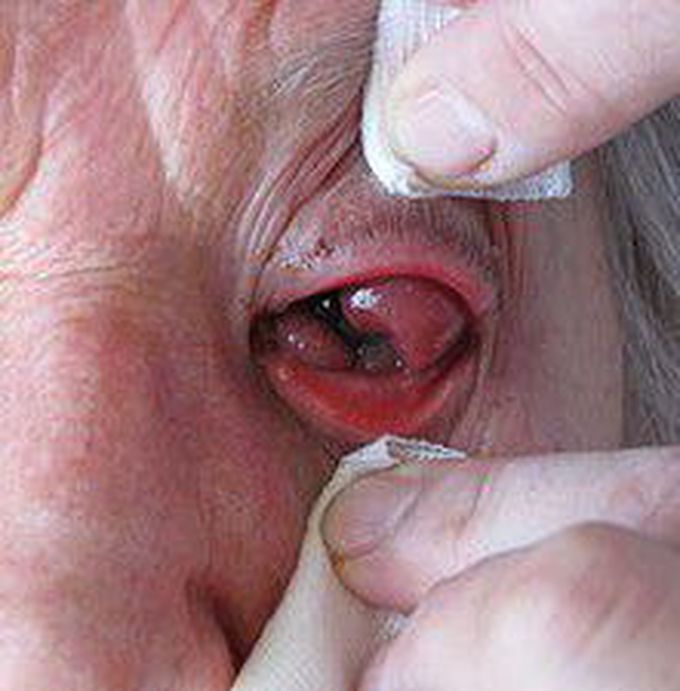 Eye cancer