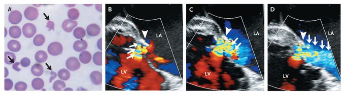 Hemolytic Anemia after Mitral-Valve Repair
