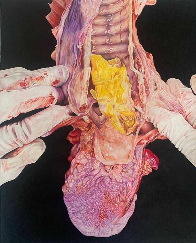 Illustration of a trachea dissected post-mortem, obstructed with an orange segment.