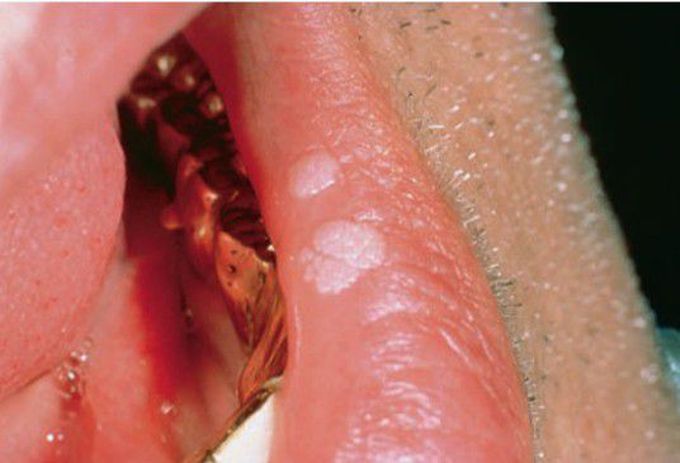 Focal epithelial hyperplasia