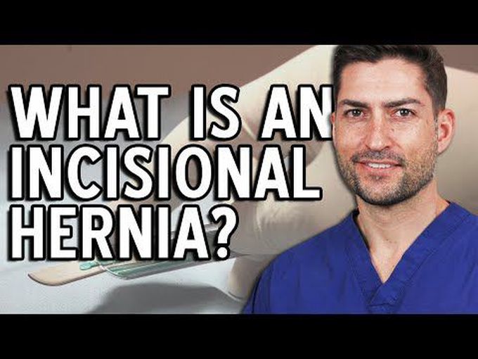 Introduction to Incisional Hernia