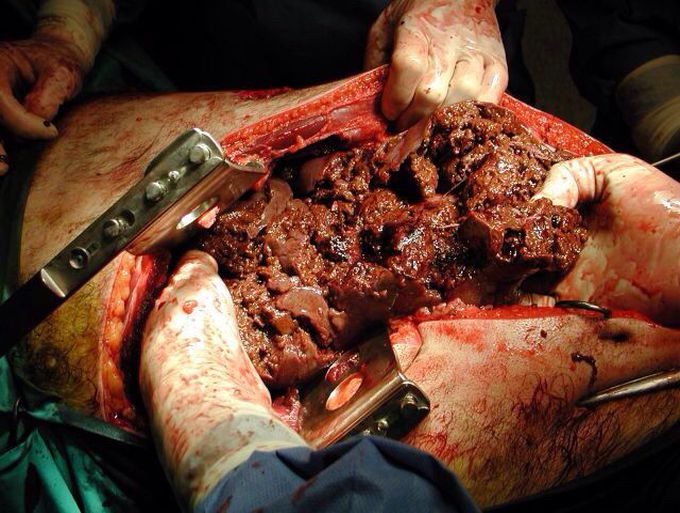 Gunshot Injury to Livergrade V liver injury after patient sustained gunshot wound to RUQ