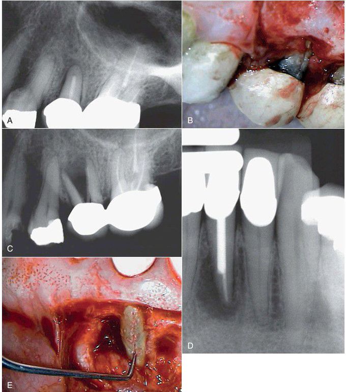 Vertical root fracture