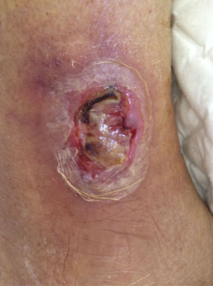 Cutaneous Manifestation of Diphtheria